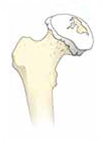 すり減った大腿骨頭の軟骨
