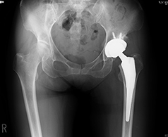 人工股関節全置換術後のレントゲン