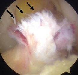損傷した前十字靭帯（黒矢印）
