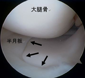 正常な内側半月板（黒矢印）