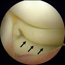 損傷した前方に逸脱した外側半月板（黒矢印）