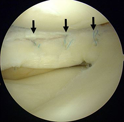 半月板縫合術後（黒矢印）