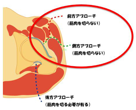 すり減った大腿骨頭の軟骨