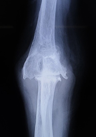 人工肘関節手術前