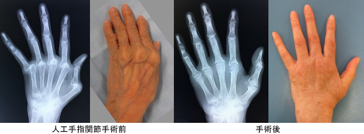 人工手指関節手術前