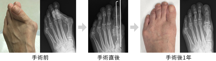 外反母趾の手術「DLMO法」